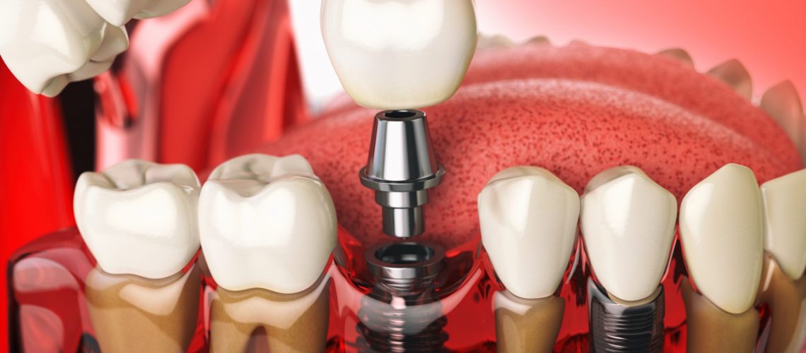 Dental Implants Fairfax, VA Are Dental Implants Safe?